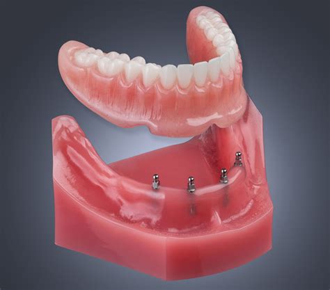 dental implant metal housing|mini dental implant systems.